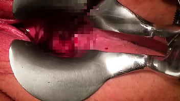 bdsm cervix dilation